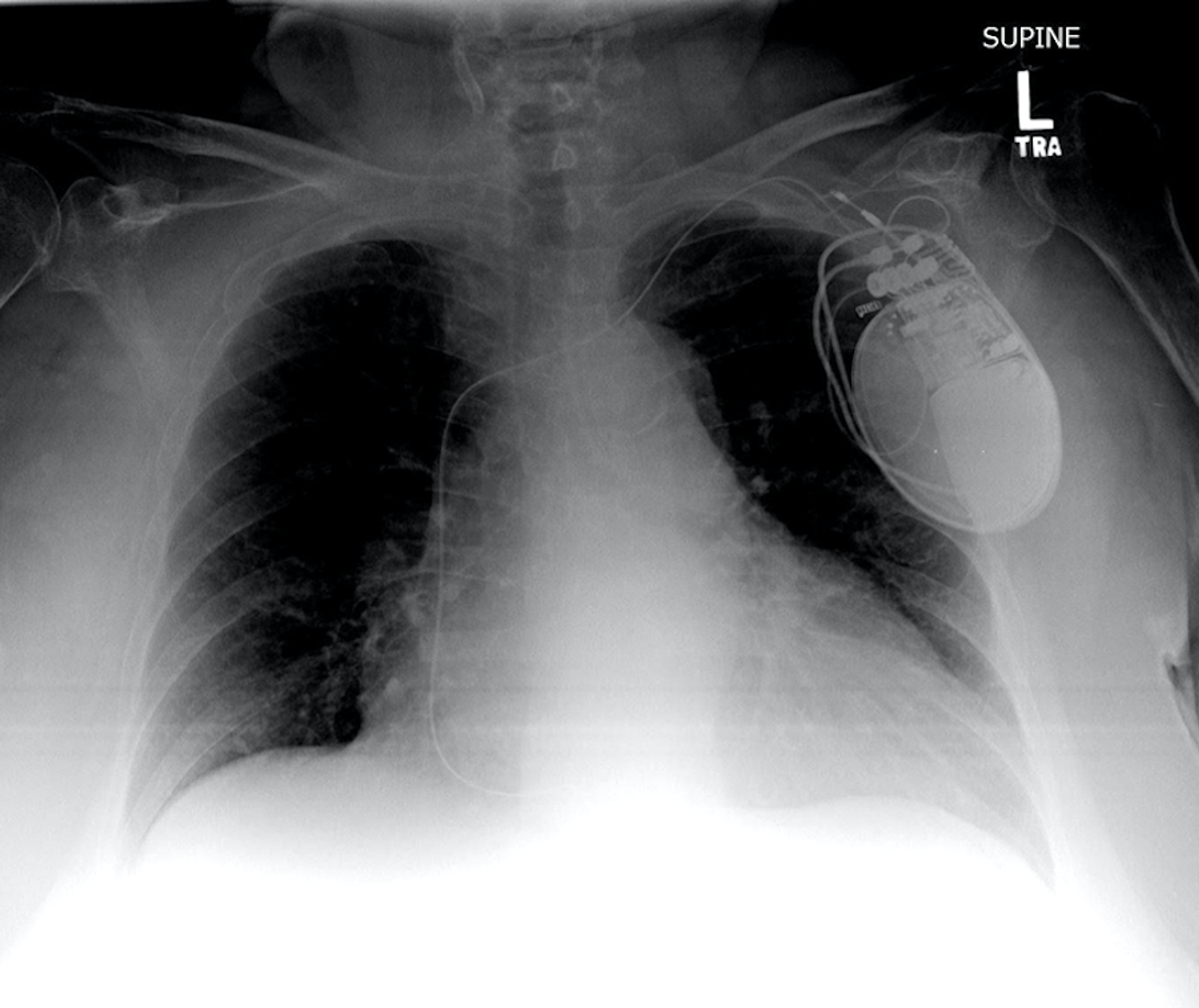 presence of pacemaker icd 10