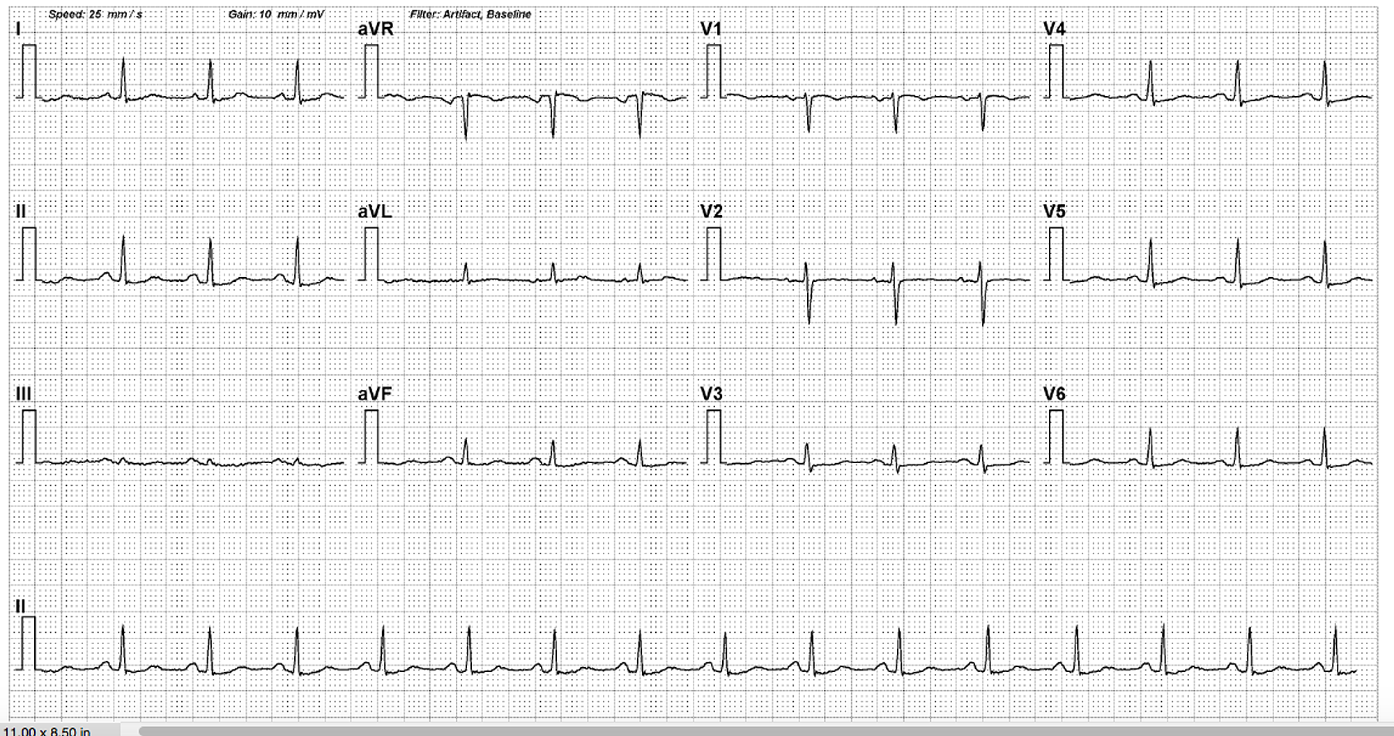 Cureus | Atrial Tachycardia Associated With a Tachycardia-Induced ...