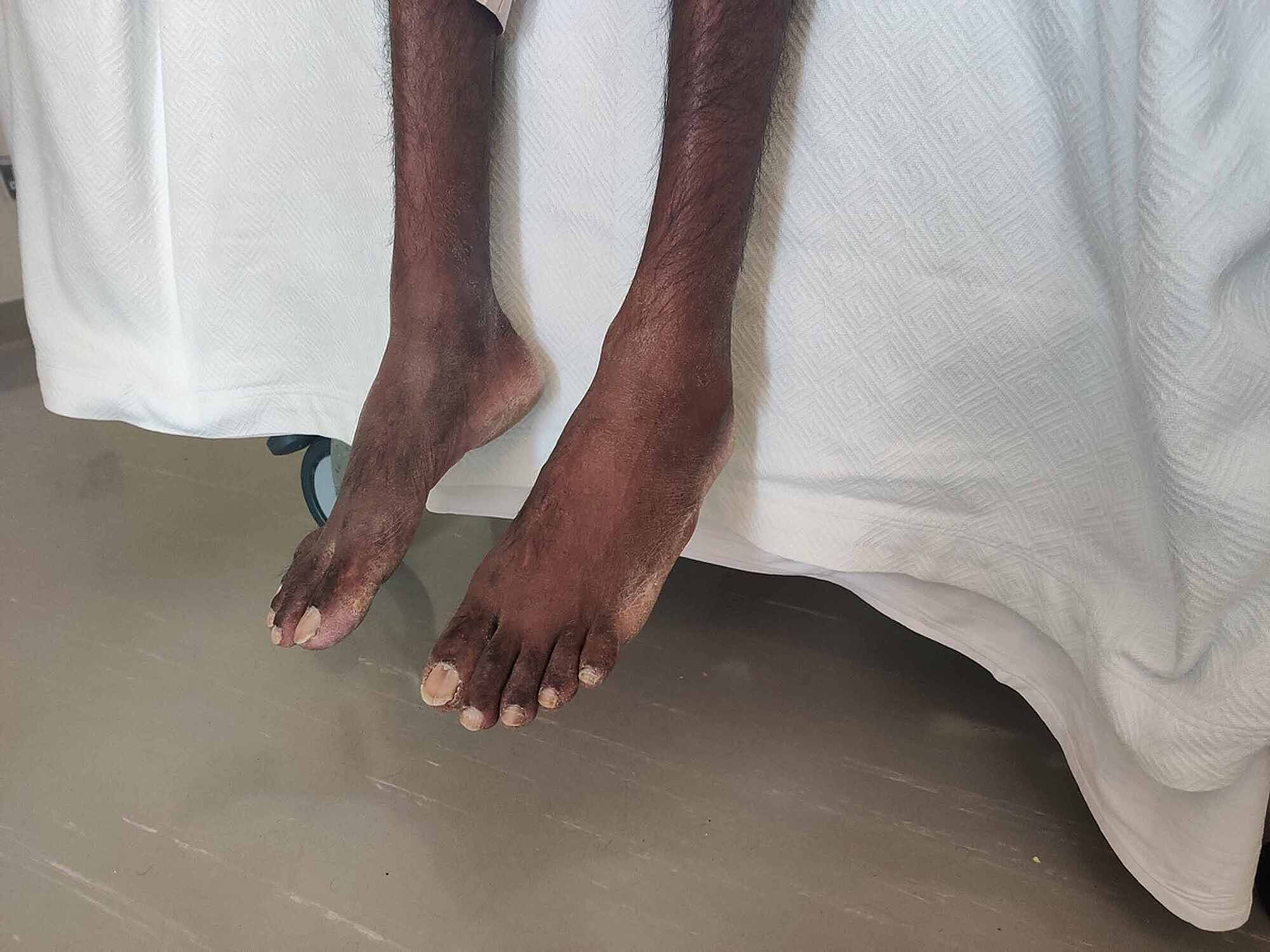 cureus-bilateral-foot-drop-secondary-to-axonal-neuropathy-in-a