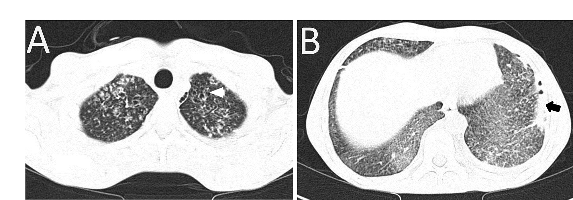 Cureus | Bilateral Foot-Drop Secondary to Axonal Neuropathy in a ...