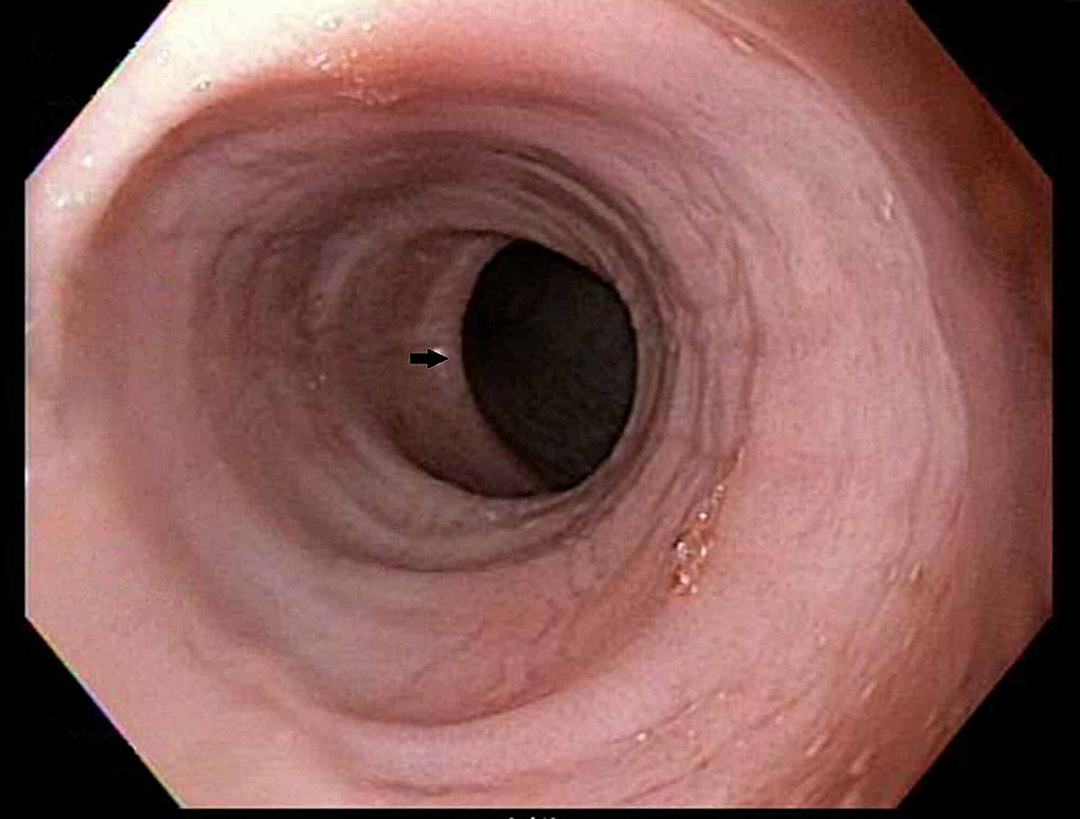 Cureus  Barrett's Esophagus in Rubinstein-Taybi Syndrome