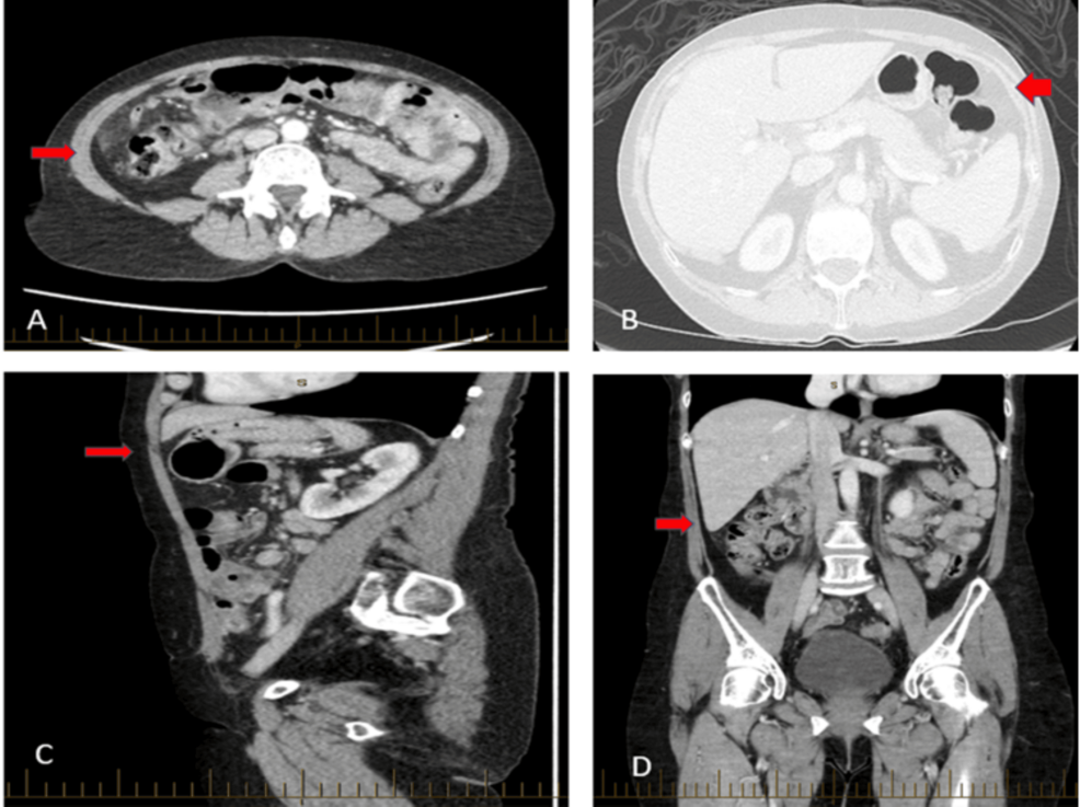 A Minimally Invasive Approach to Caecal Volvulus: A Rare Complication of Colonoscopy