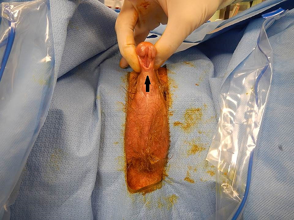 congenital adrenal hyperplasia women