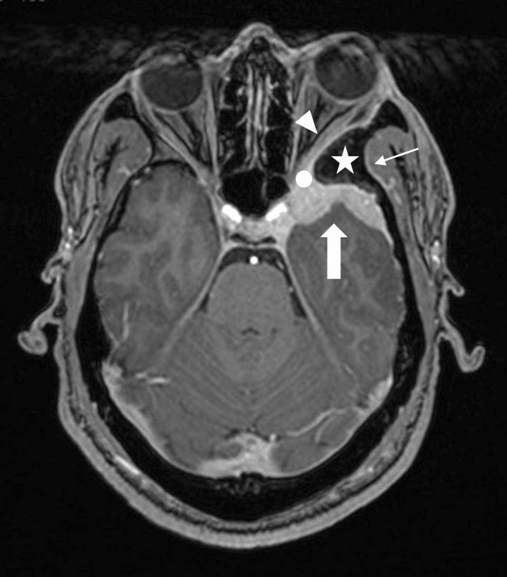 metastatic melanotic peripheral nerve Melanotan-1  Ultra Labs