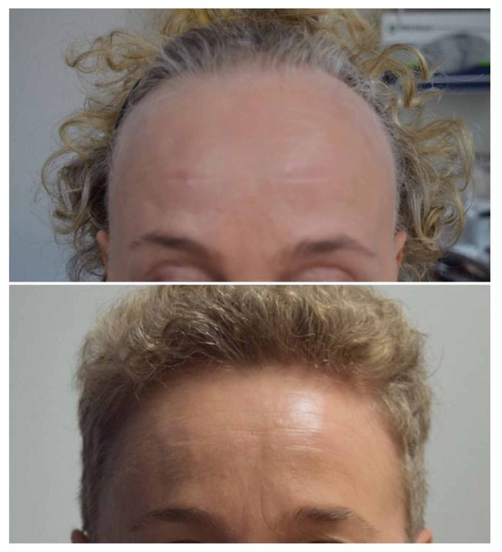 Receding hairline Treatment stages and causes