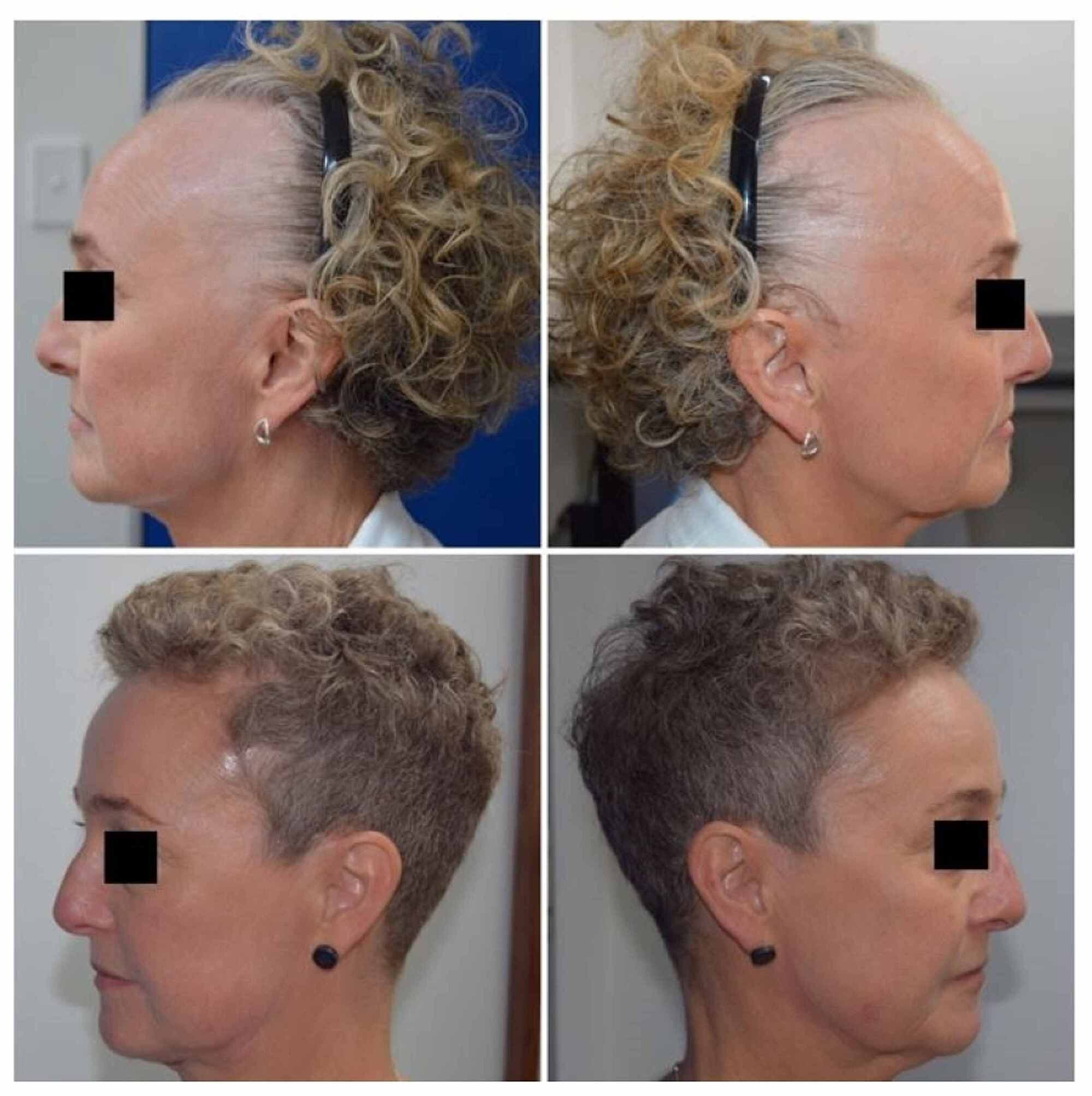 Reversal of Frontal Hair Loss from Propecia with Photos  WRassmanMD  BaldingBlog