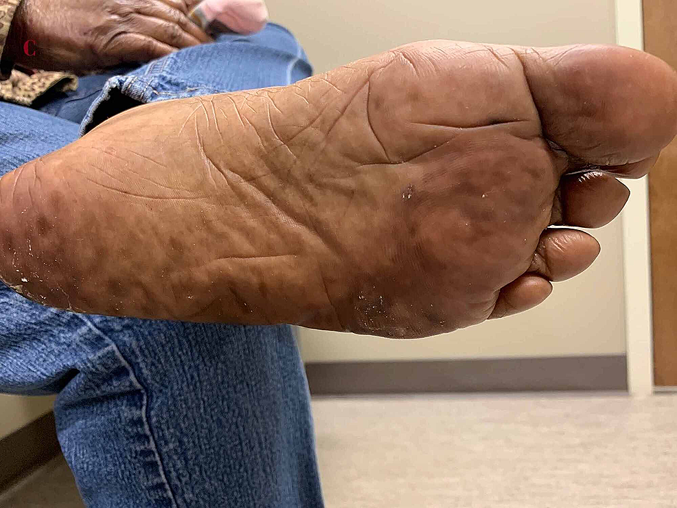 Cureus PaclitaxelInduced PalmarPlantar Erythrodysesthesia