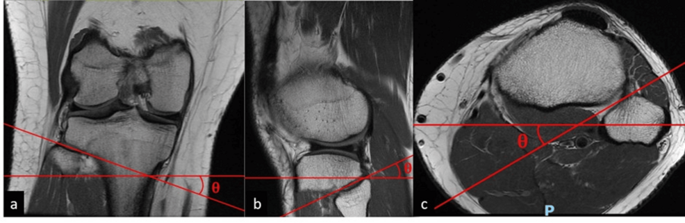 健康・医学 MRI ARTHROSCOPY and SURGICAL ANATOMY CT- and MRI-Based 3D Reconstruction of Knee Joint to Assess