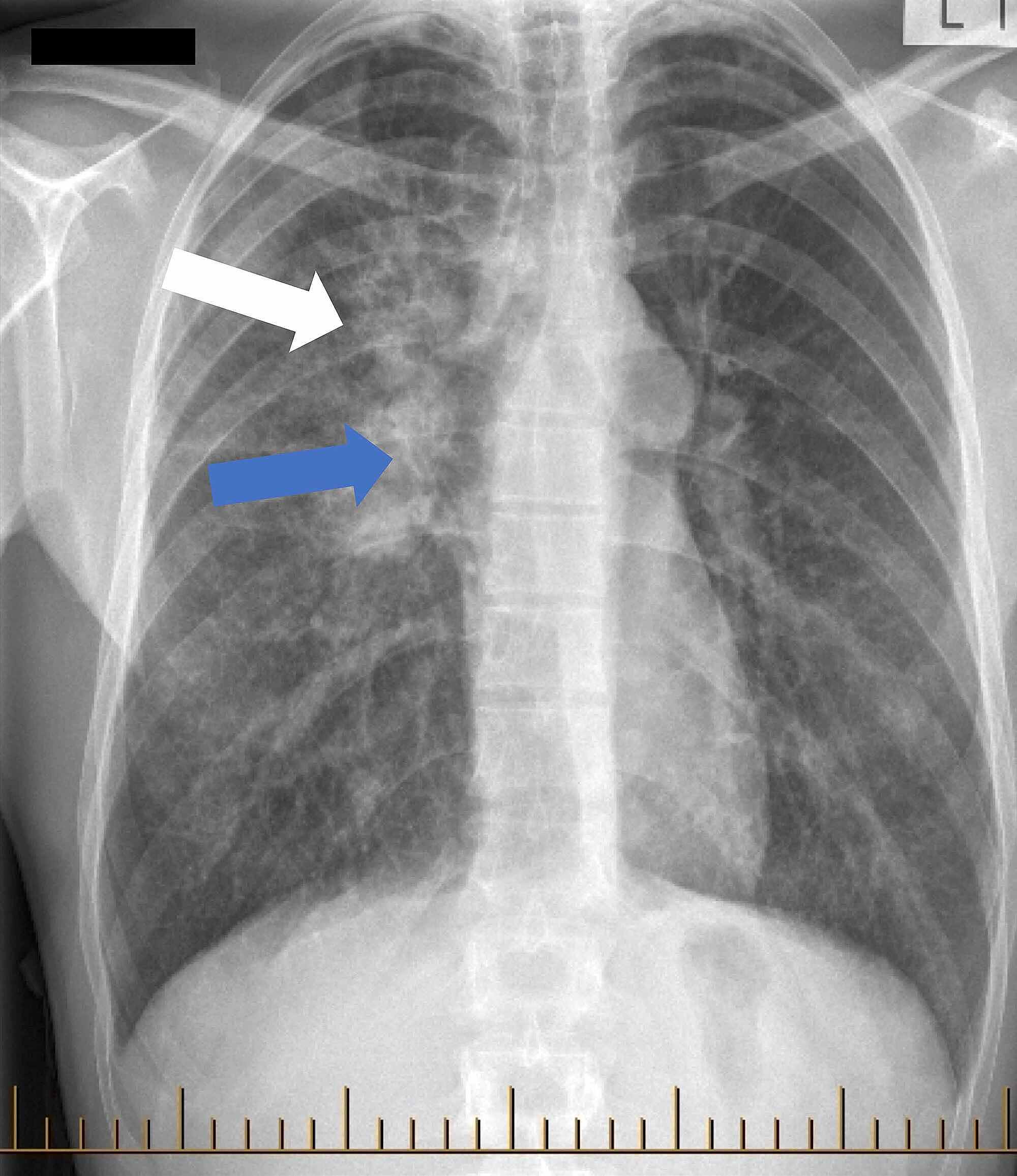 Cureus Tuberculosis And Sarcoidosis Overlap A Clinical Challenge   29d2e8a02dc411ebac6f0fe658bf2965 Figure 1  