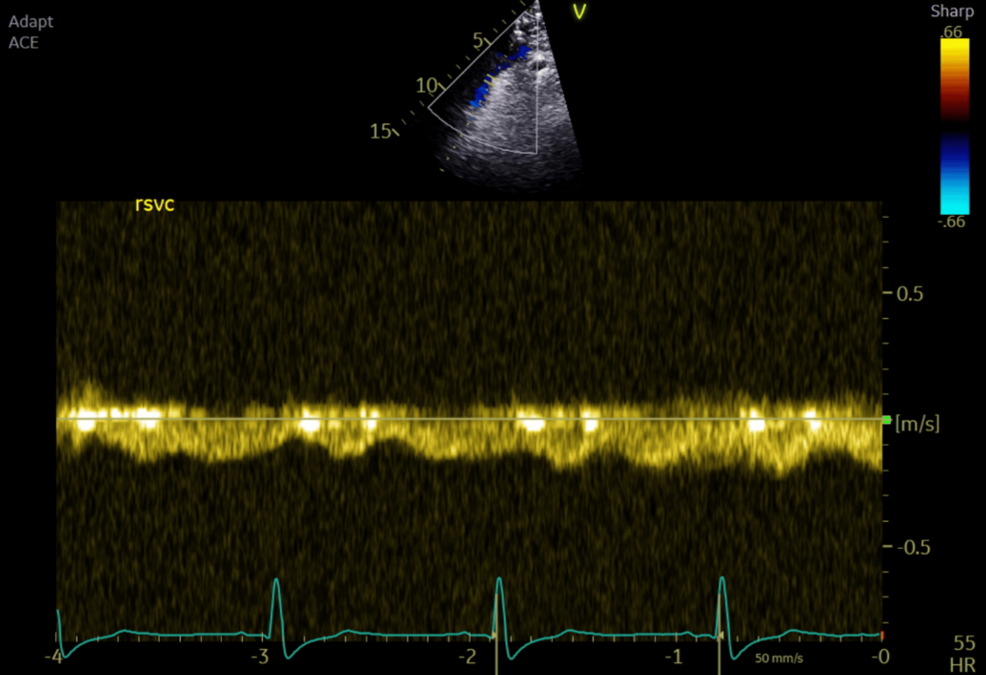 Velocities-in-the-extra-cardiac-conduit-showing-laminar-flow-with-positive-pressure-ventilation-variations Velocities-in-the-extra-cardiac-conduit-showing-laminar-flow-with-positive-pressure-ventilation-variations