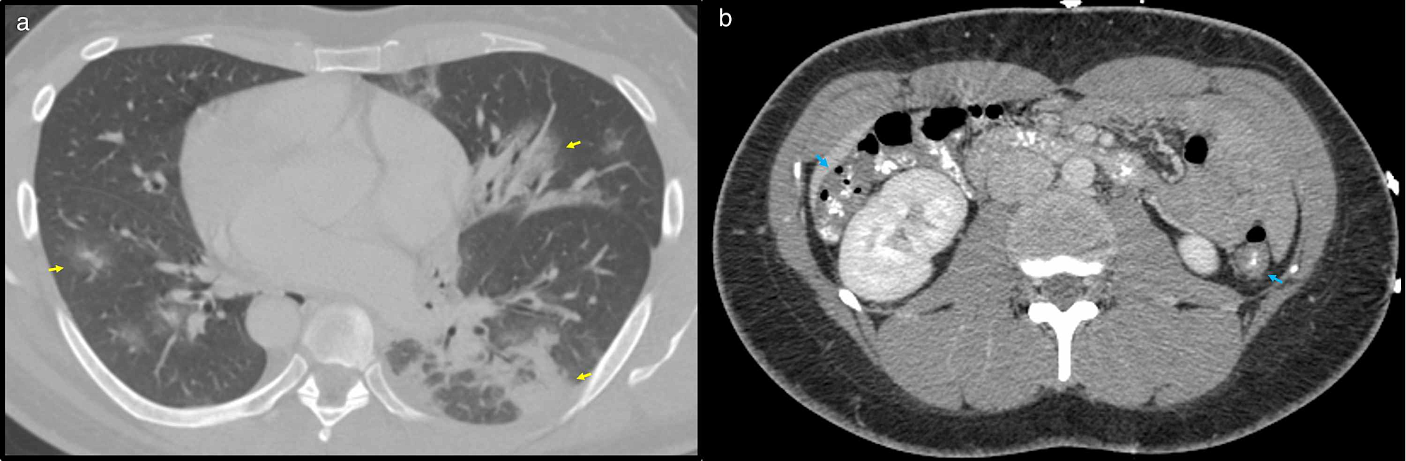 Cureus Early Diagnosis of COVID19 on NonChest CT