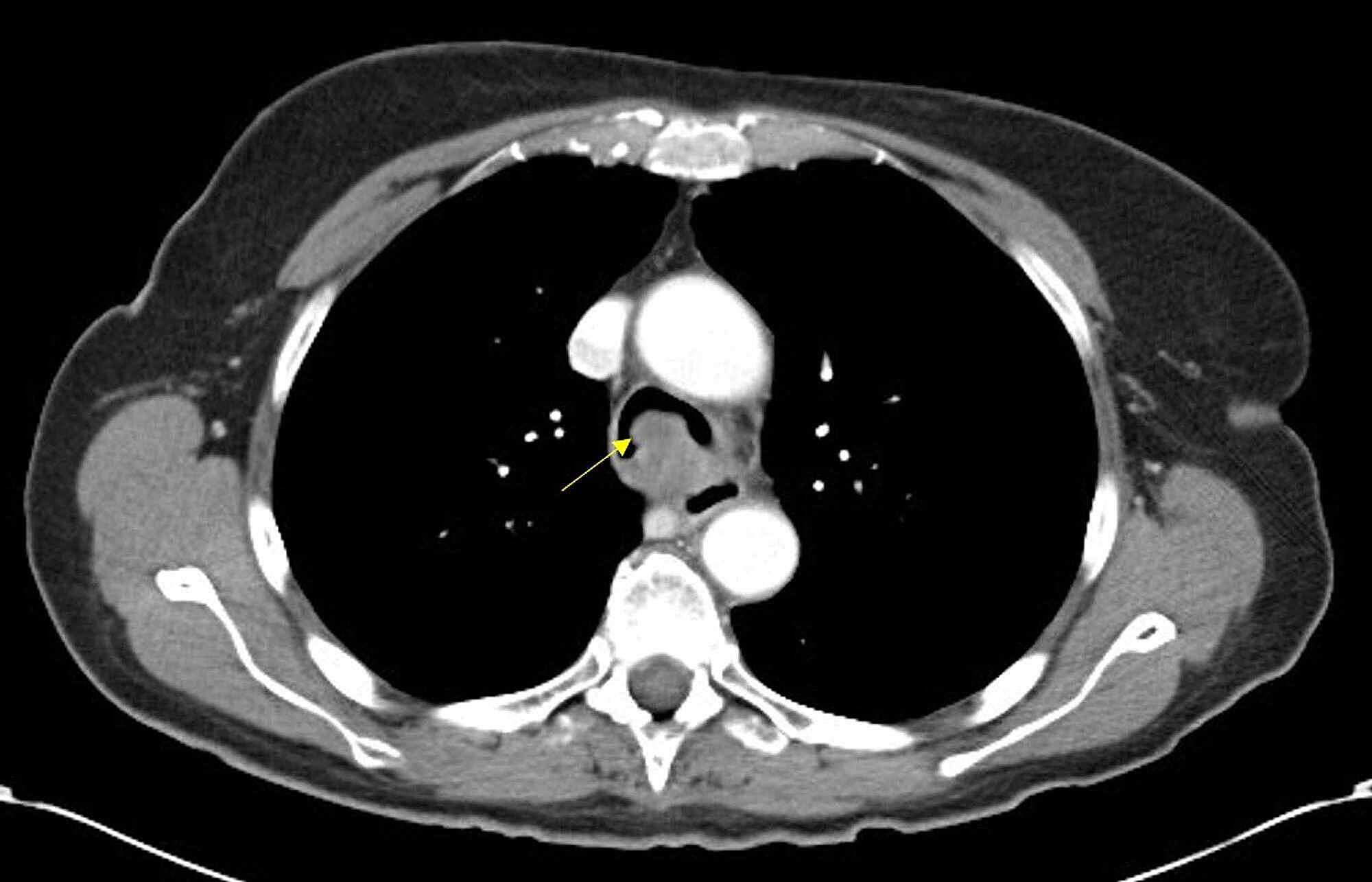 Cureus Huffing and Puffing A Rare Case of Tracheal Adenoid Cystic