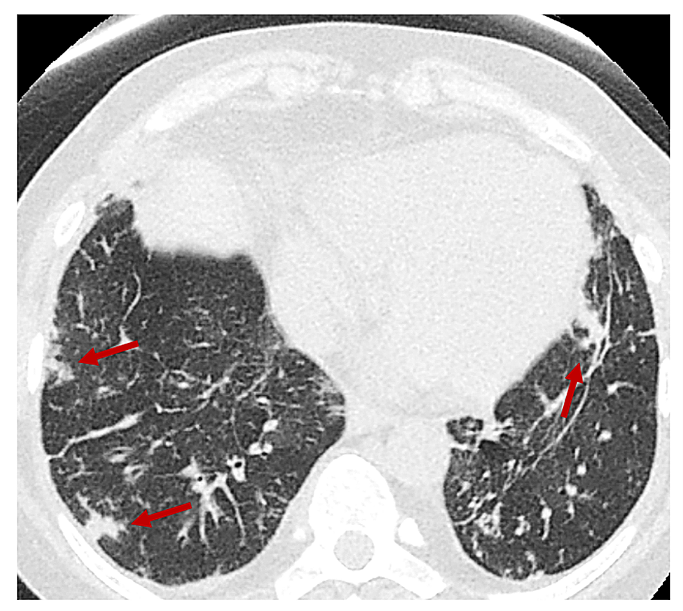 Chest-CT-without-contrast-at-admission-showing-multiple-areas-of-nodularity-(red-arrows)-revealing-possible-septic-embolic-disease.