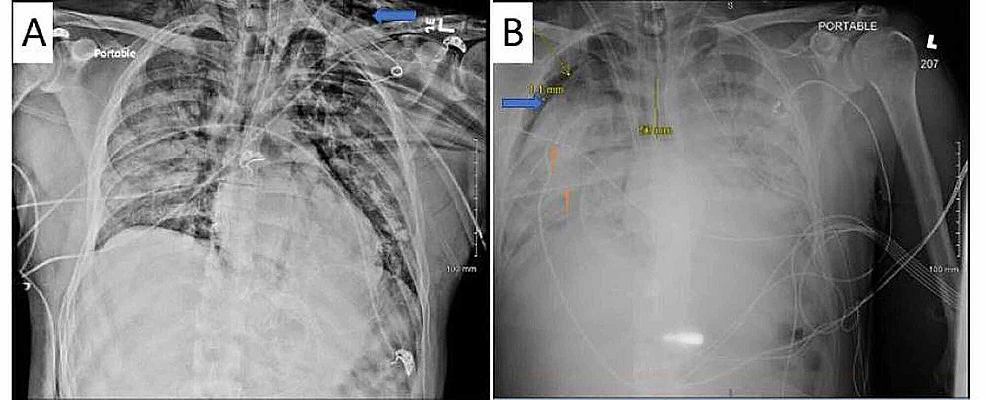 (A)-Chest-radiograph-showing-left-sided-subcutaneous-emphysema-{blue-arrow}--(B)-Persistent-right-sided-pneumothorax-(blue-arrow)-even-with-placement-of-two-right-sided-chest-tubes-(orange-arrows).-Also-noted-on-this-image-is-the-right-internal-jugular-extracorporeal-membrane-oxygenation-(ECMO)-cannula.-