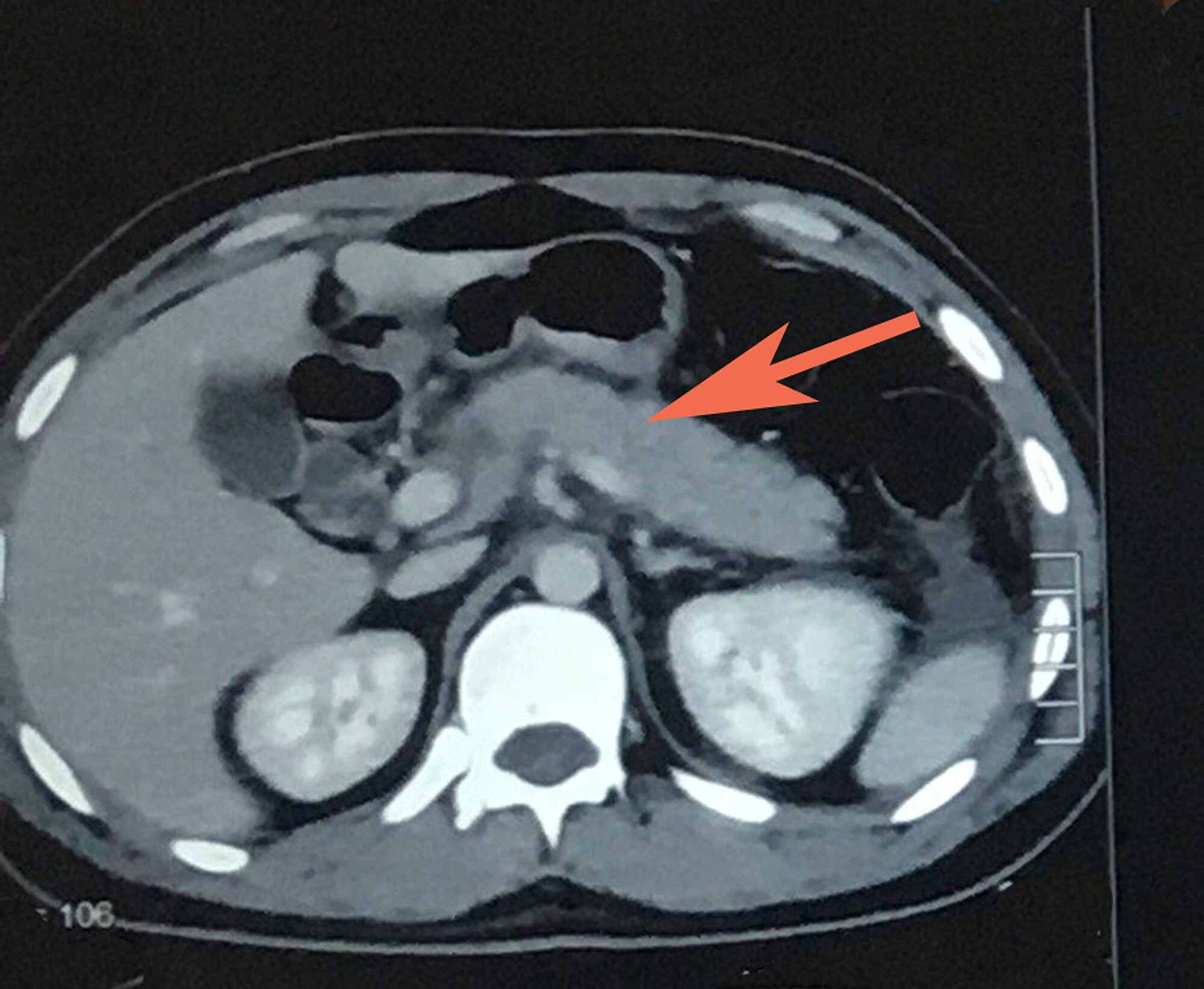 cureus-ascaris-lumbricoides-infestation-as-an-unexpected-cause-of