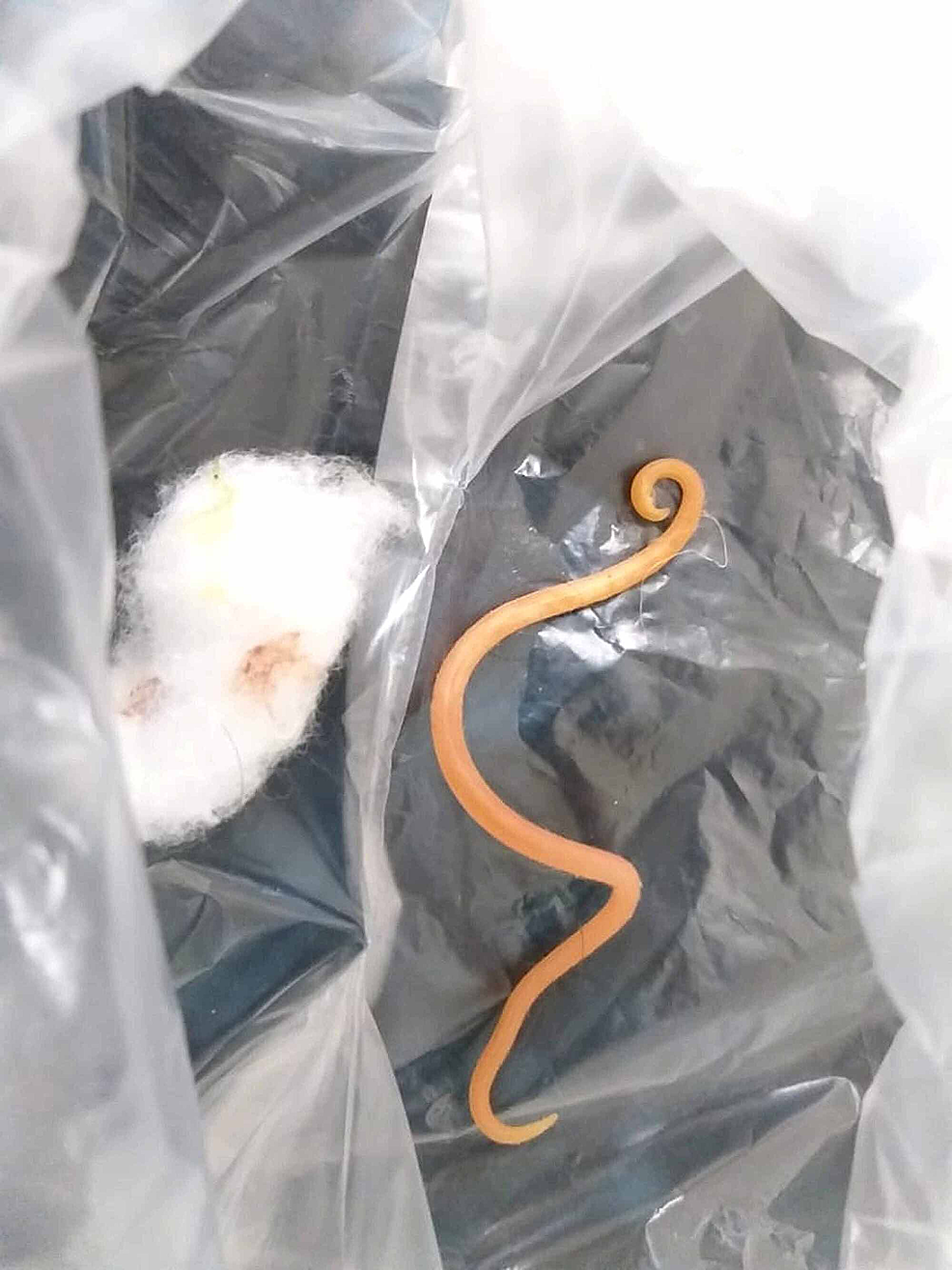 Cureus Ascaris Lumbricoides Infestation as an Unexpected Cause of