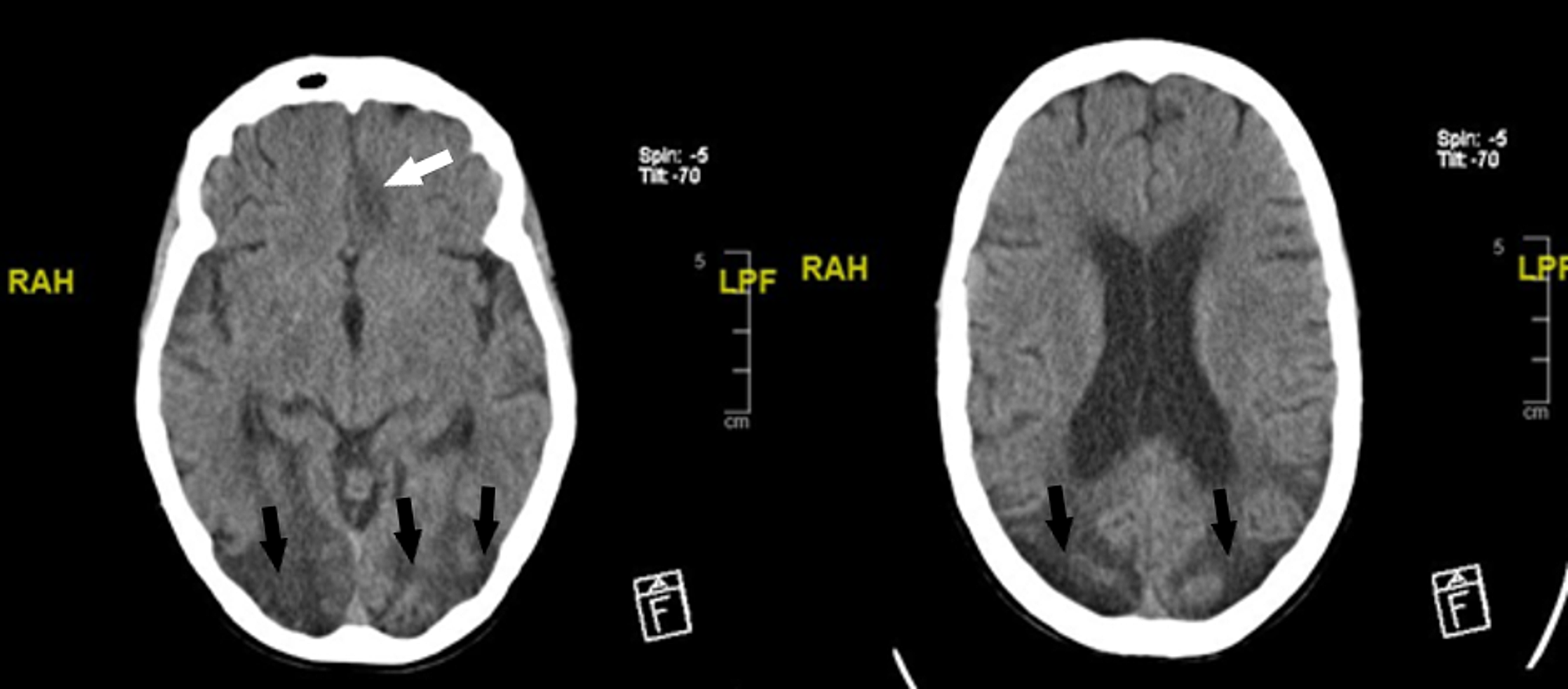 Cureus | Recurrent Stroke Events Secondary to a Late Presentation of ...