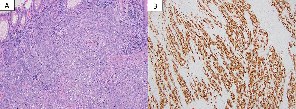 Cureus | Extramedullary Hematopoiesis in Mismatch Repair Deficient ...