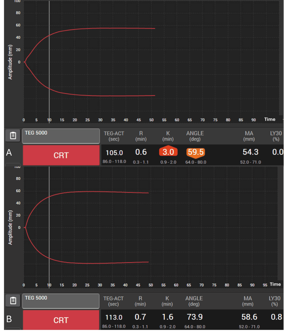 Advancements in Fibrinogen Replacement for Major Bleeding: Insights From  Case Series | Cureus