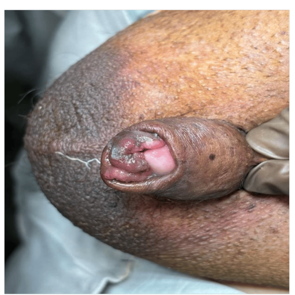 Metastatic Adenocarcinoma of the Prostate Presenting as a Penile Mass in a Patient With Acute Urinary Retention: A Case Report