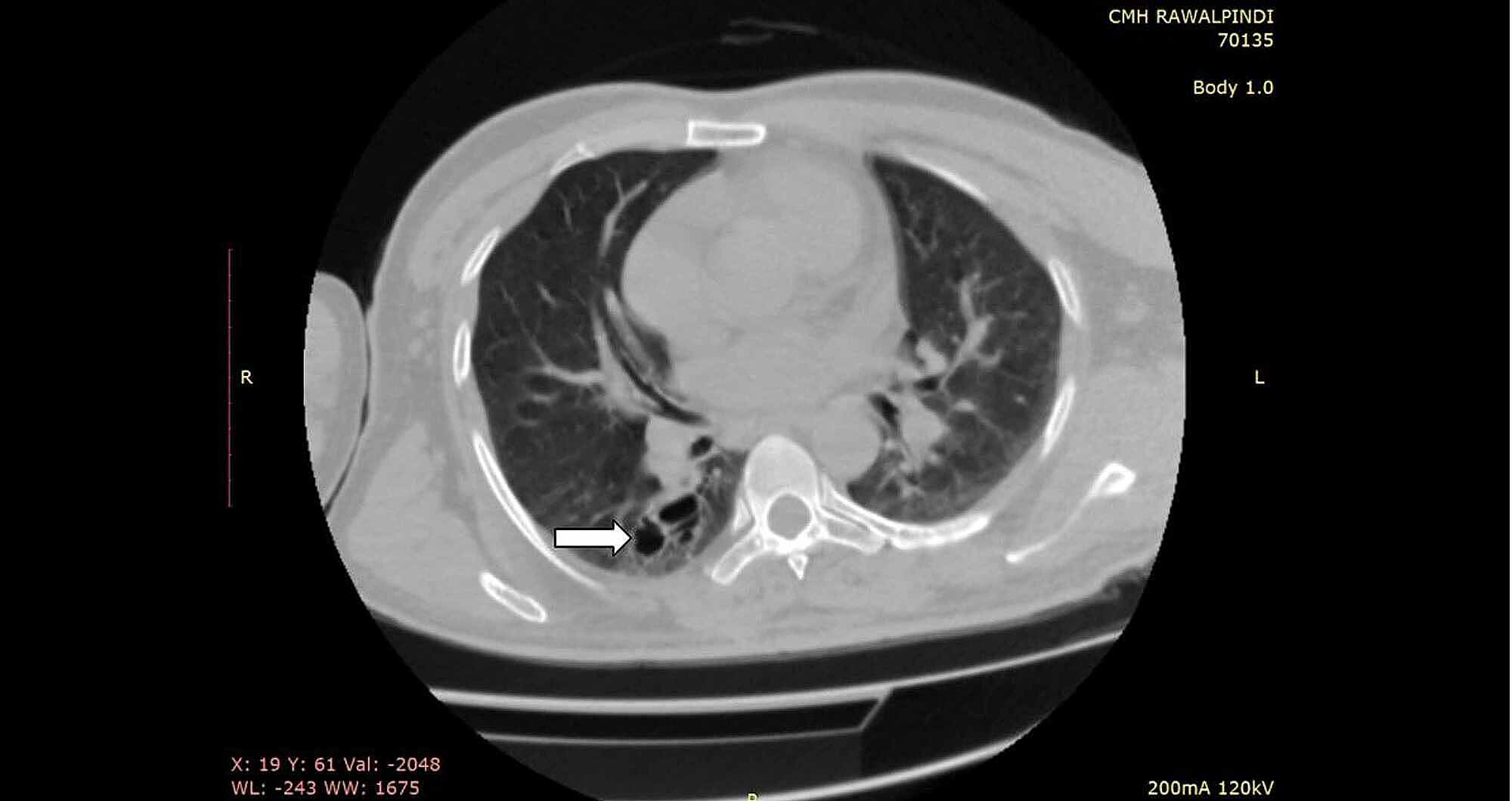 Cureus | Tuberculosis-Induced Bronchiectasis Complicated by Recurrent ...