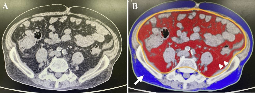 シタグリプチンとエンパグリフロジン併用療法の有効性charcot-marie-tooth疾患と併存糖症糖尿病患者における有効性：症例報告