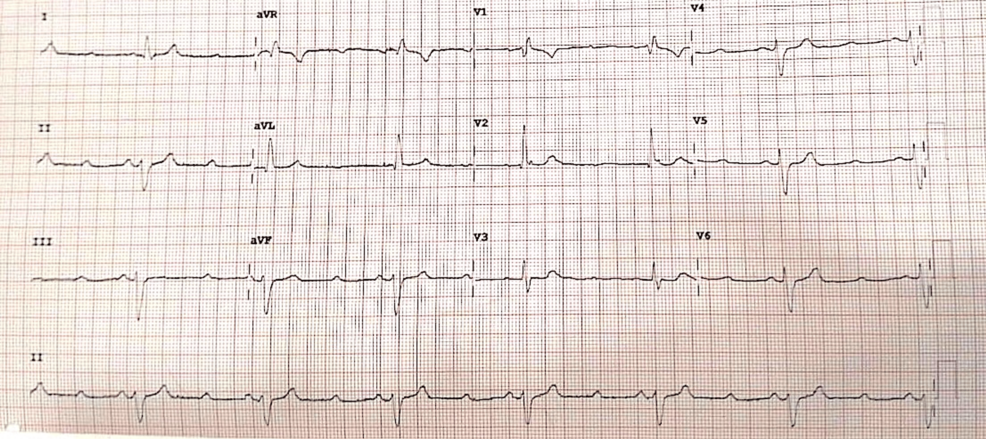 Cardiac Conduction Defects Induced by Paracetamol Overdose: A Rare Case