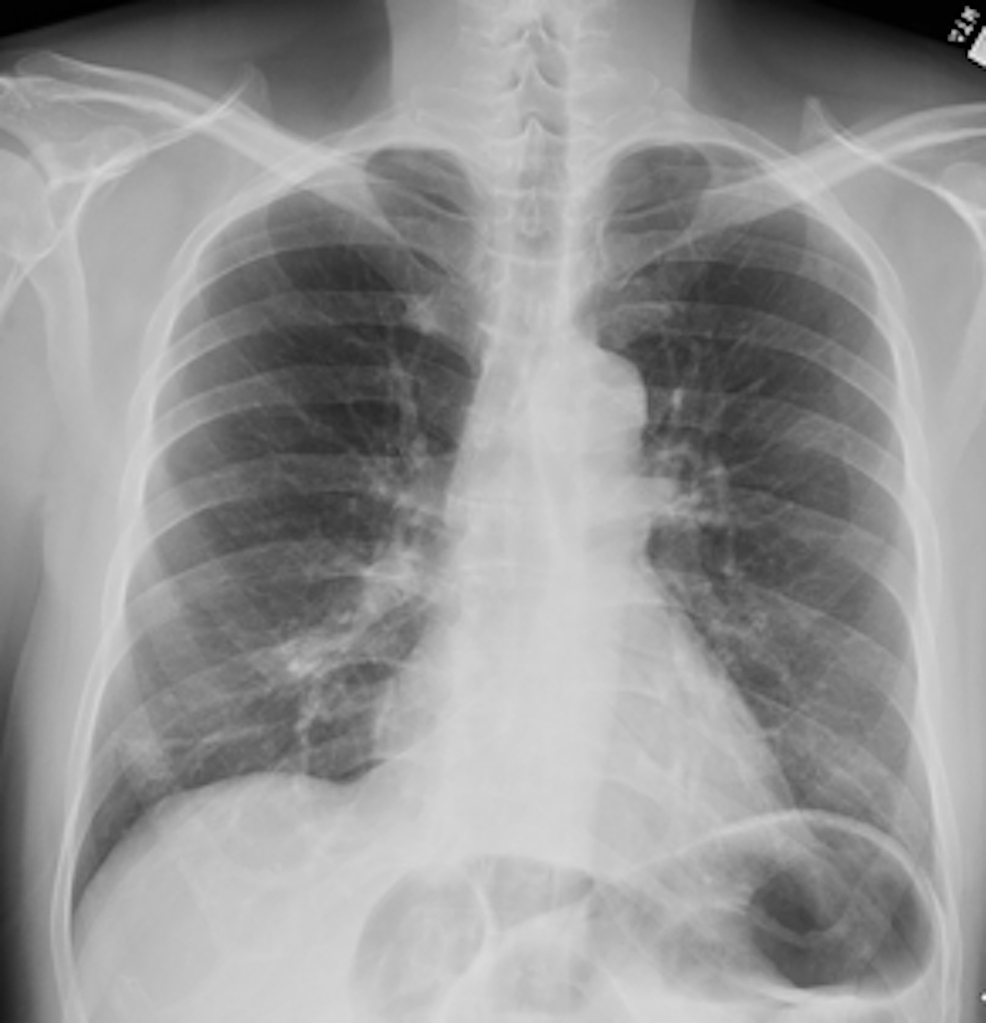 Cureus | A Rare Case of Pulmonary Mucosa-Associated Lymphoid Tissue ...