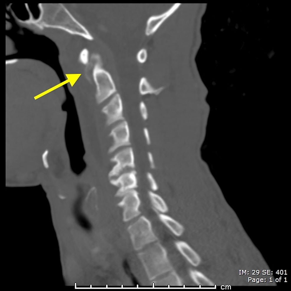 Gluteus Medius Calcific Tendinitis