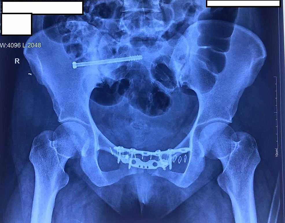 Cureus Late Onset Sacroiliac Osteoarthritis After Surgical 