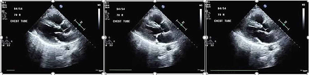Echocardiogram-showing-right-ventricular-free-wall-hypokinesia