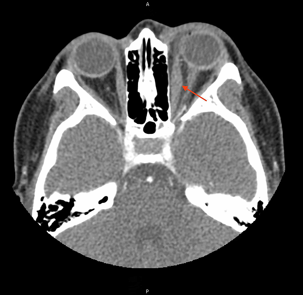 CT-image-with-contrast-showing-left-medial-rectus-swelling