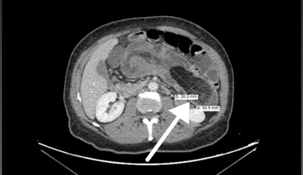 Rare Presentation of Cecocolic Intussusception From a Colonic Lipoma: A Case Report