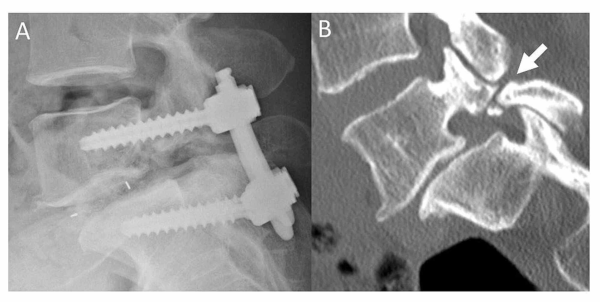 Cureus | Influence Of Spondylolysis On Clinical Presentations In ...