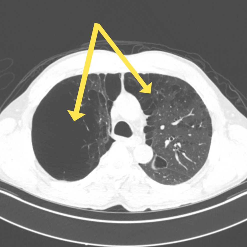 Perioperative Management of a Patient With Severe Bullous Emphysema