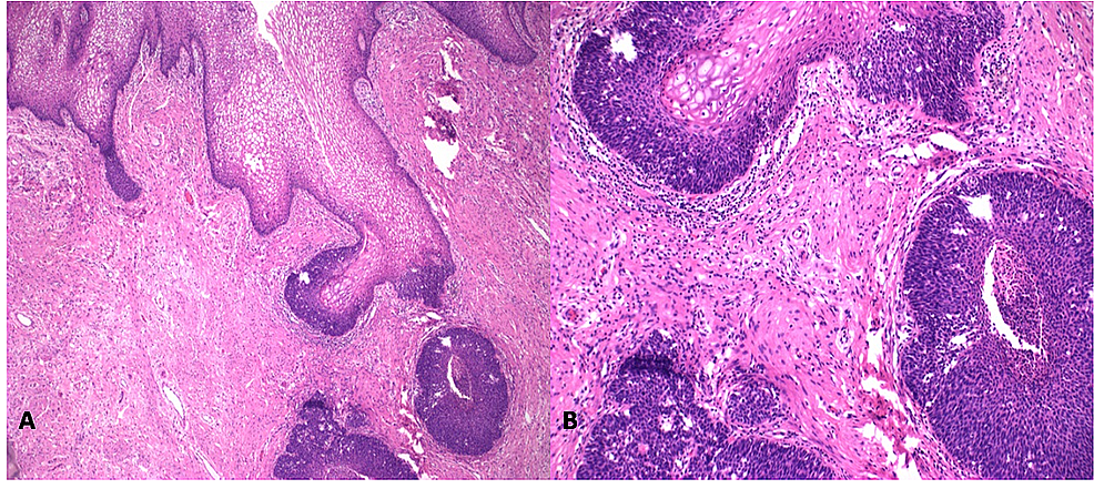 Cureus | Decidualized Stroma in Pelvic Lymph Nodes in a Pregnant ...