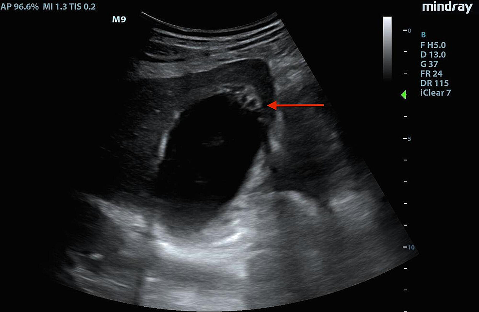 Cureus The Effervescent Gallbladder An Emergency Medicine Bedside
