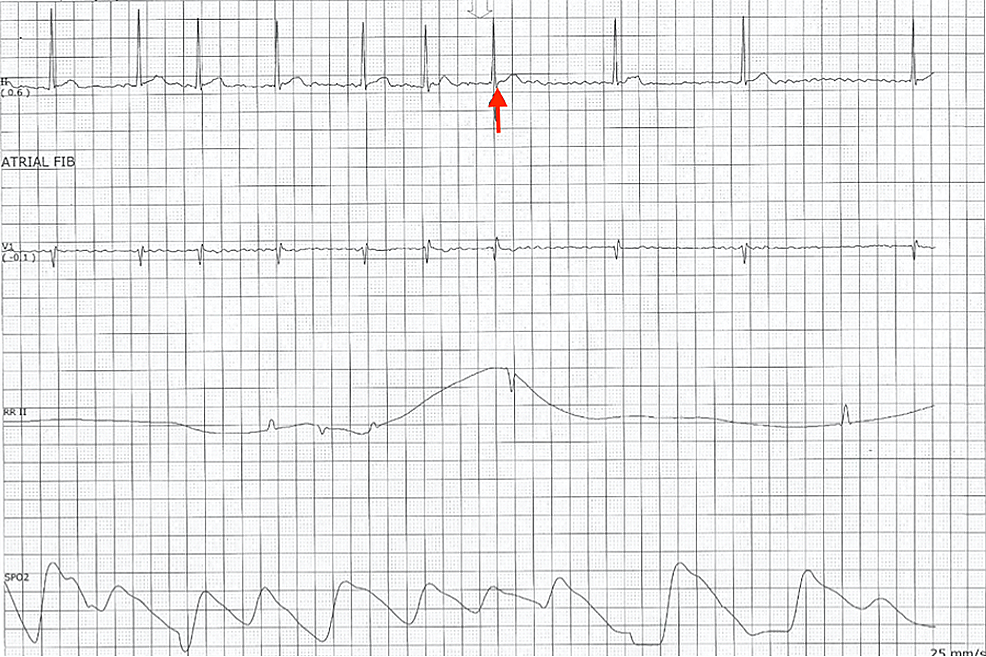 Cureus Cardiac Arrest Following Treatment With Diltiazem for Atrial
