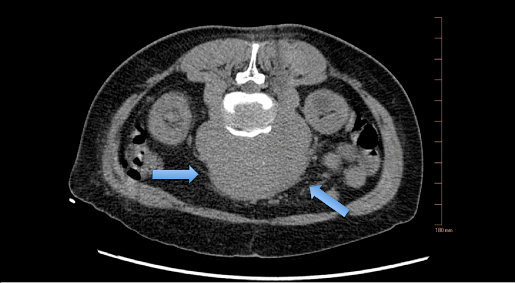 Cureus Concurrent Incidental Presentation Of Primary Retroperitoneal   Lightbox 6844d3002dba11ebbbcbe58320463c19 Screen Shot 2020 11 23 At 1.31.43 PM 