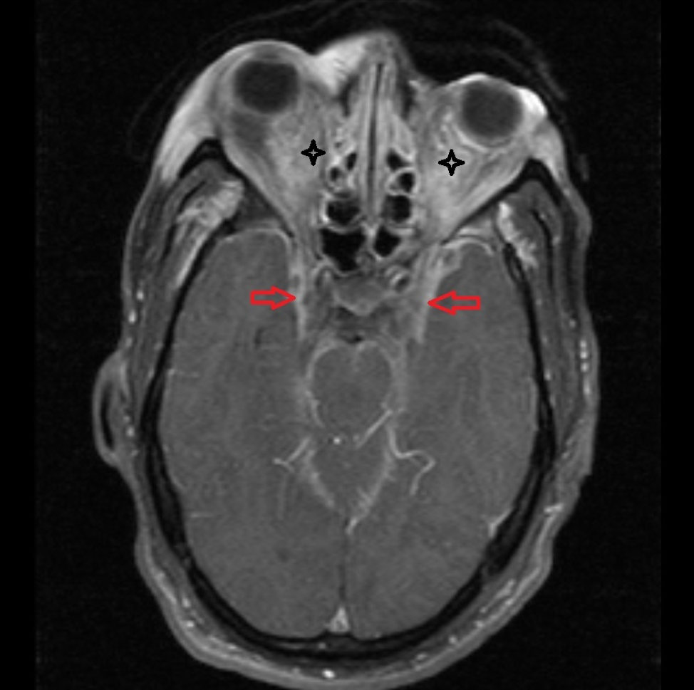 Cureus | Infective Endocarditis Presenting as Bilateral Orbital ...