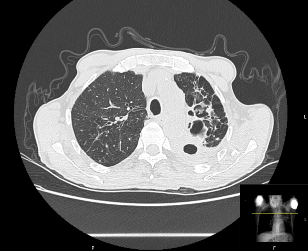 肺アスペルギローマに続発する大規模なhemoptysisの緊急肺炎切除術の麻酔管理：症例報告