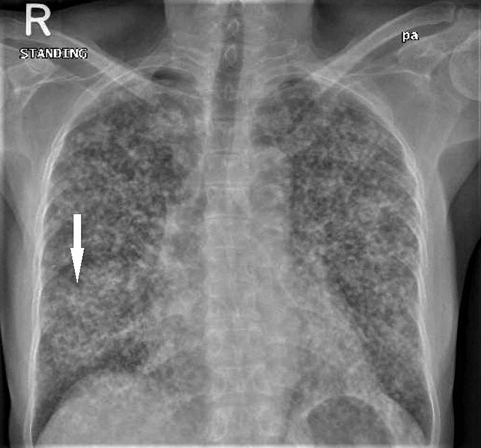 cureus-metastatic-adenocarcinoma-of-the-lung-mimicking-miliary