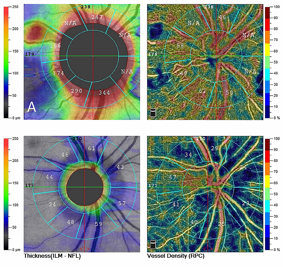 Cureus | Non-Arteritic Anterior Ischemic Optic Neuropathy (NAION ...