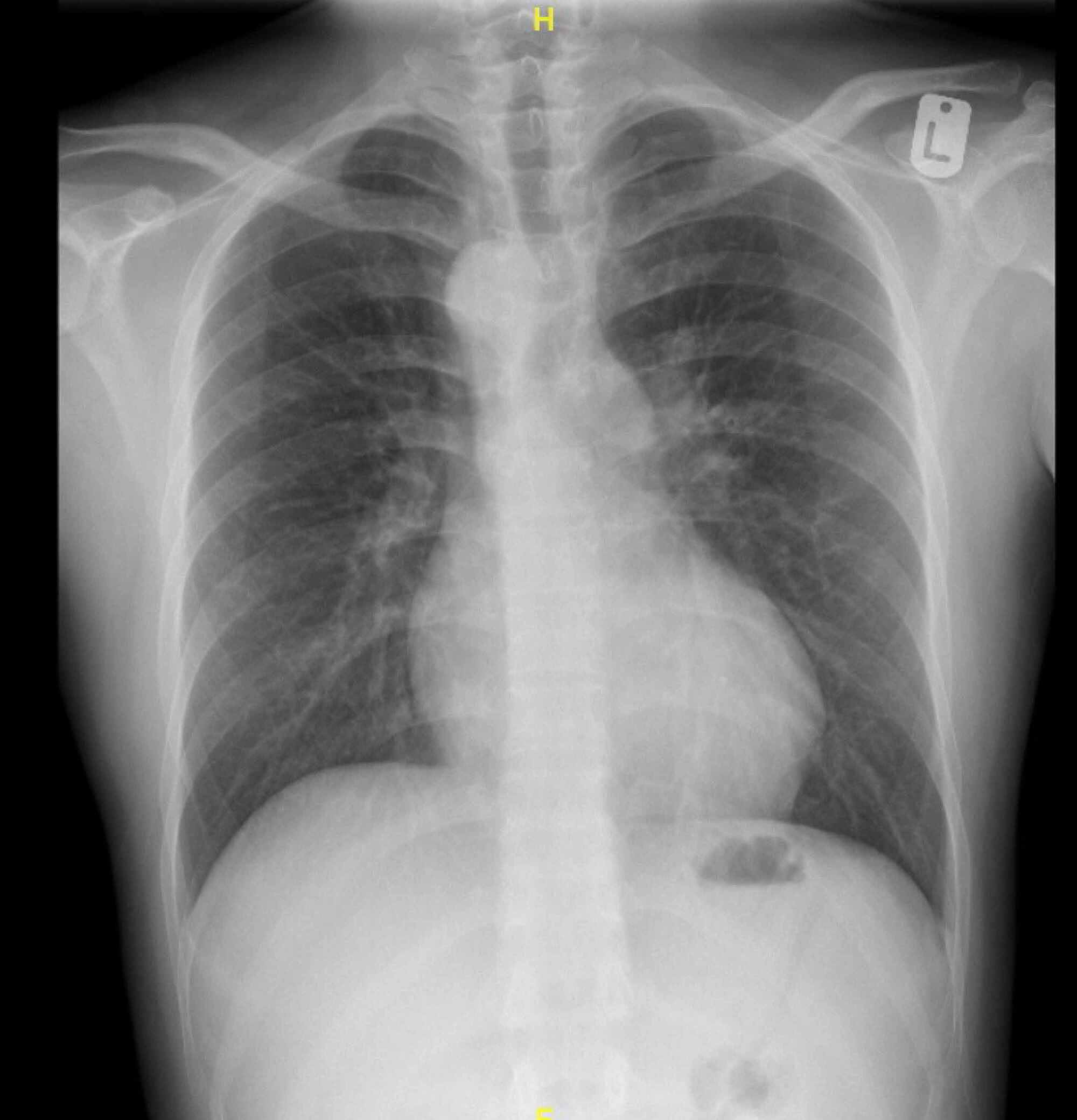 Cureus | An Adult Patient With a Tetralogy of Fallot Case