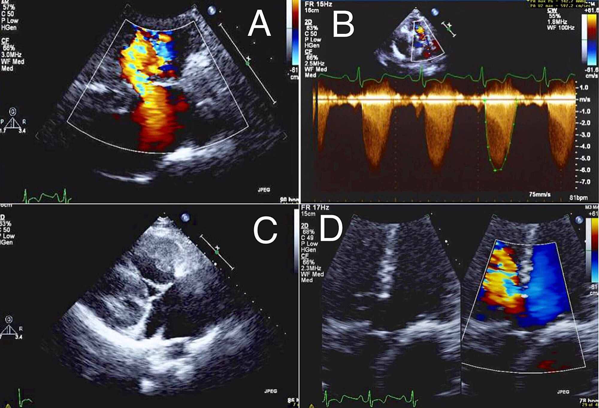 tetralogy of fallot case study scribd