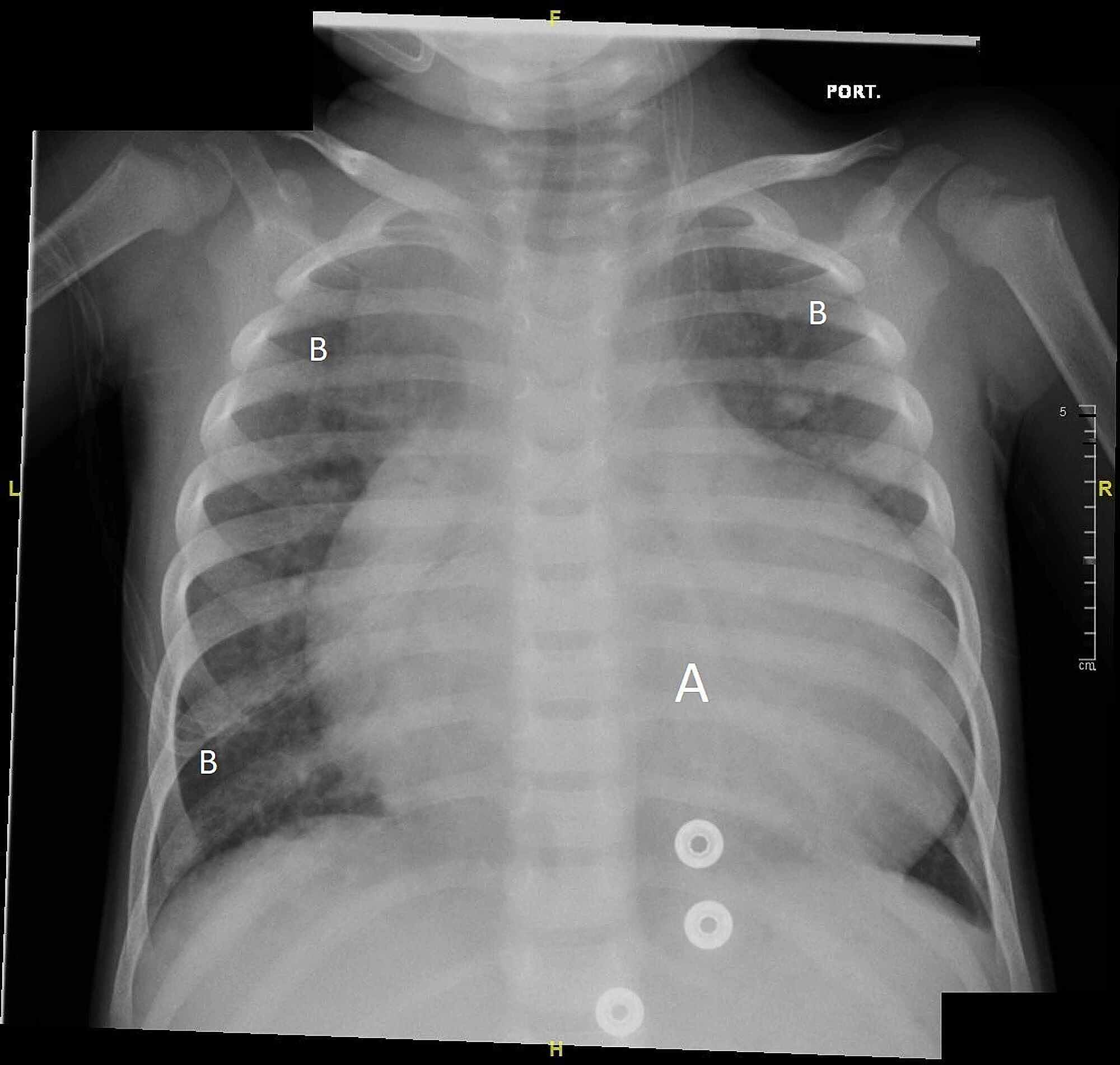Cureus Covid 19 In A Three Year Old Girl With Total Anomalous Pulmonary Venous Return A Case Report