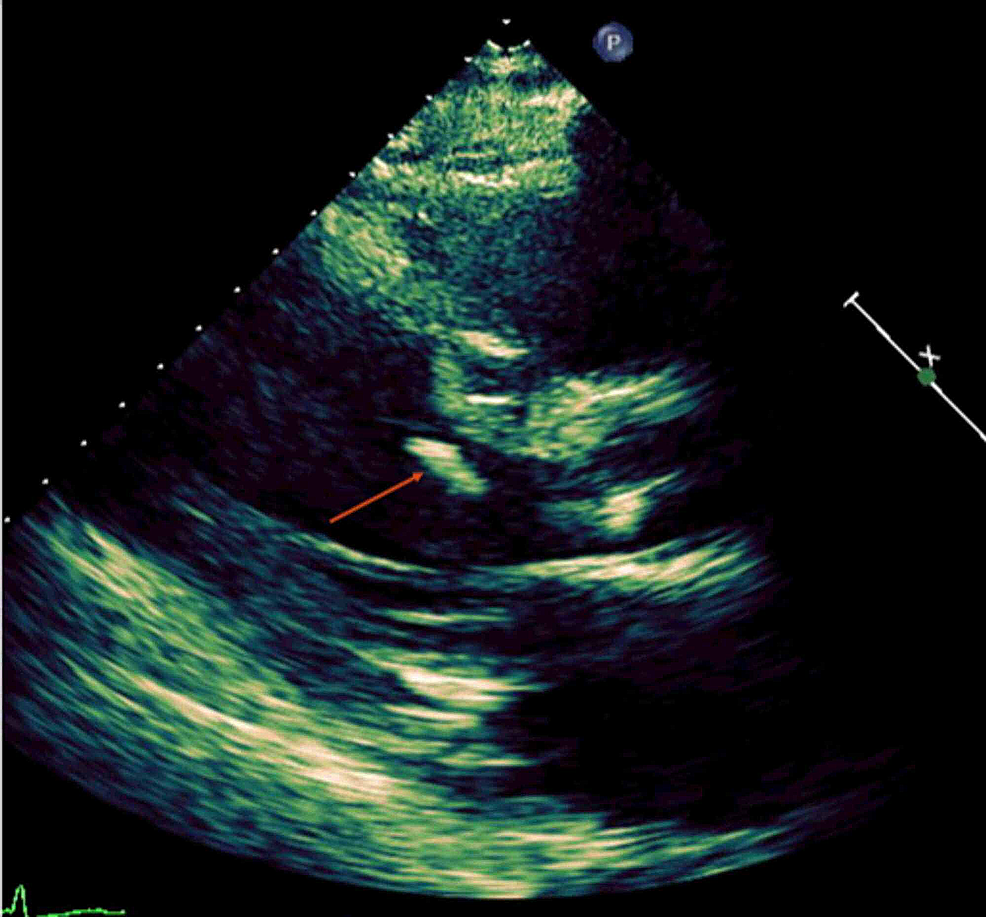 Cureus | Ruptured Left Ventricular False Tendon Mimicking a Mural ...