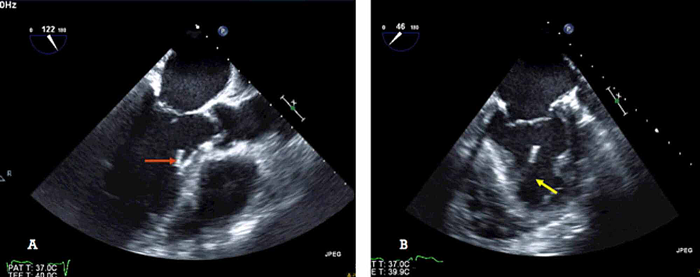 Cureus | Ruptured Left Ventricular False Tendon Mimicking a Mural ...