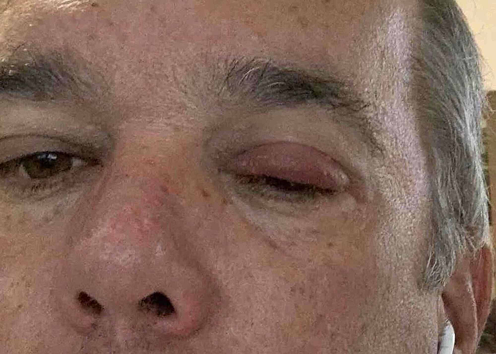 Cureus The Ocular Manifestations of COVID19 Through