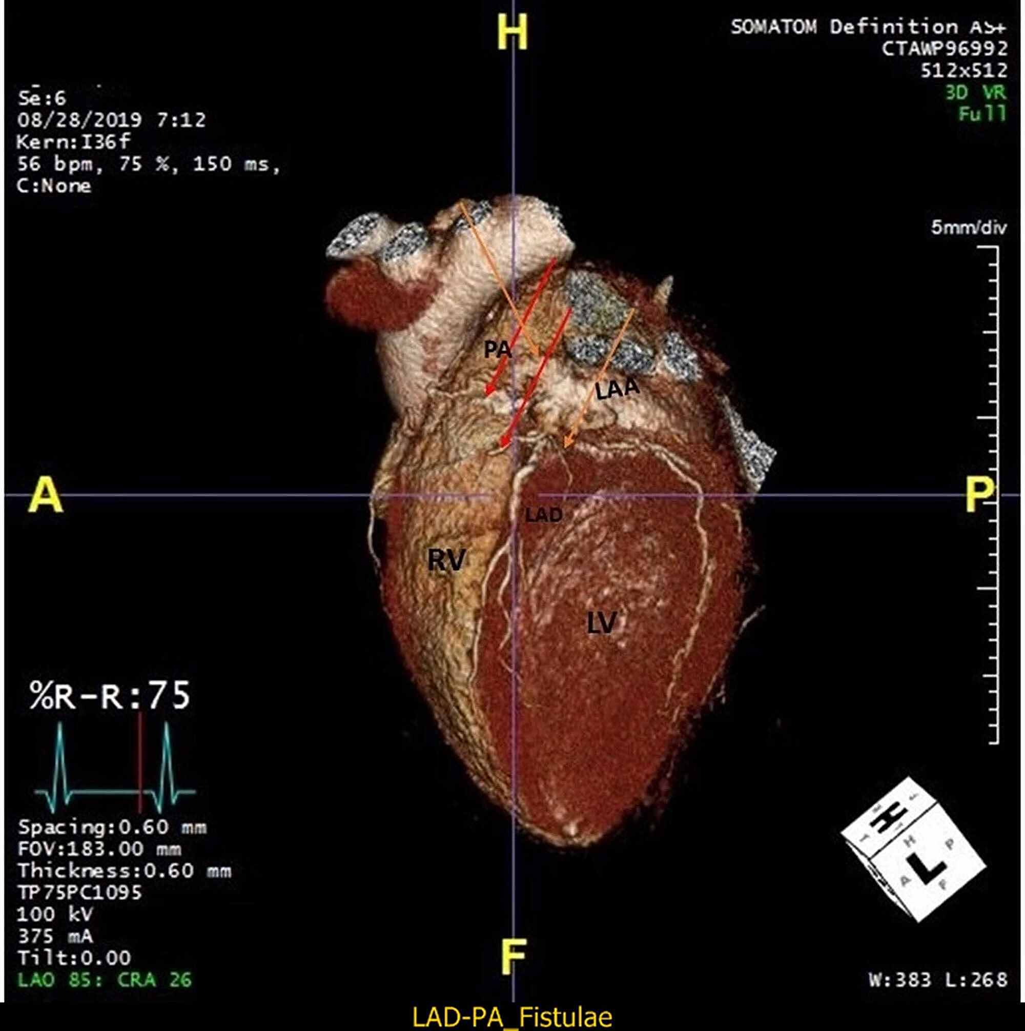 Cureus | Coronary Steal in a Patient With Apical Hypertrophic ...